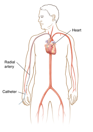 Outline of a male figure showing transradial cardiac catheterization.